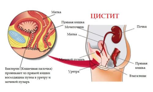 Выделяют 2 большие группы циститов: инфекционной и неинфекционной природы