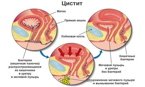 Схема заражения мочевого пузыря