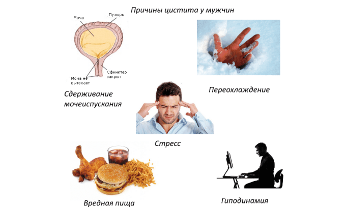 У мужчин цистит в острой форме может возникнуть на фоне воспаления предстательной железы, орхоэпидидимита и воспаления уретры