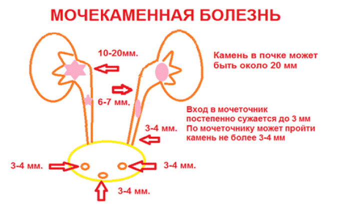 Схема мочекаменной болезни