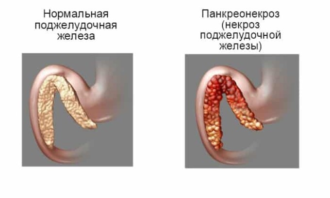 При панкреонекрозе поджелудочная железа требует оперативного лечения