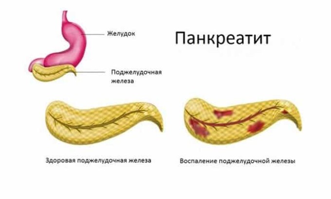 Ферменты поджелудочной железы помогают переваривать пищу. Если этот орган работает исправно, то нет никаких проблем с усвоением белков, жиров, углеводов