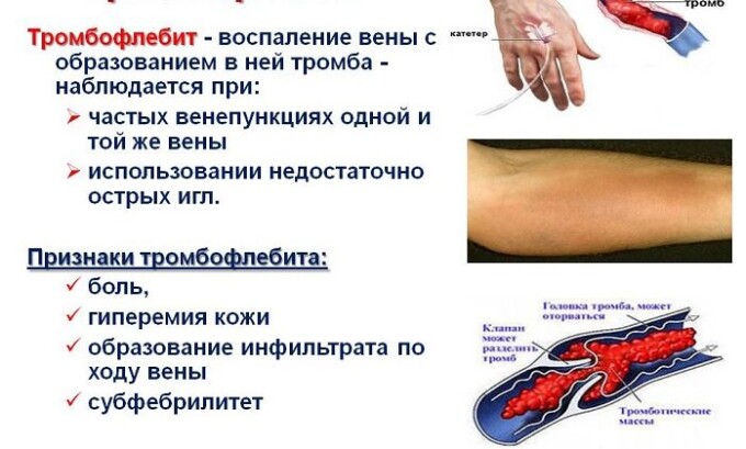 Наличие острого тромбофлебита является показанием к проведению операции