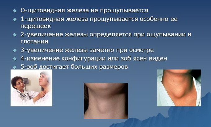 Степени увеличения щитовидной железы