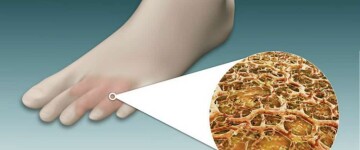 Лечение грибка стопы народными средствами (запущенная форма)