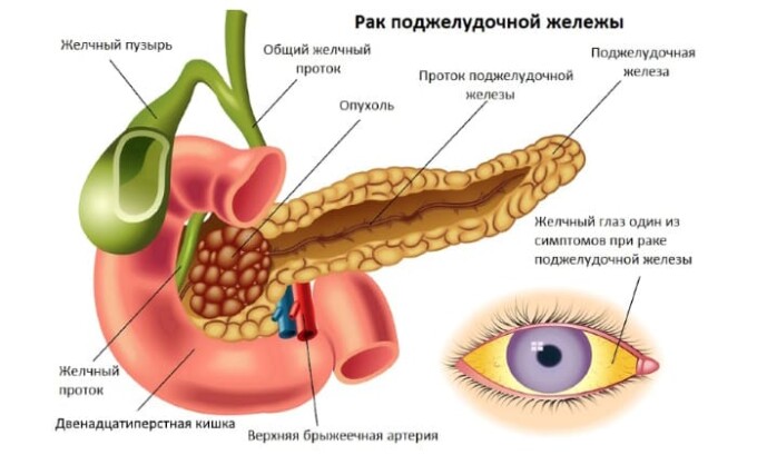 Первые опухоли развиваются из особых клеток, они производят выделение большого количества гормонов. Это влияет на весь организм