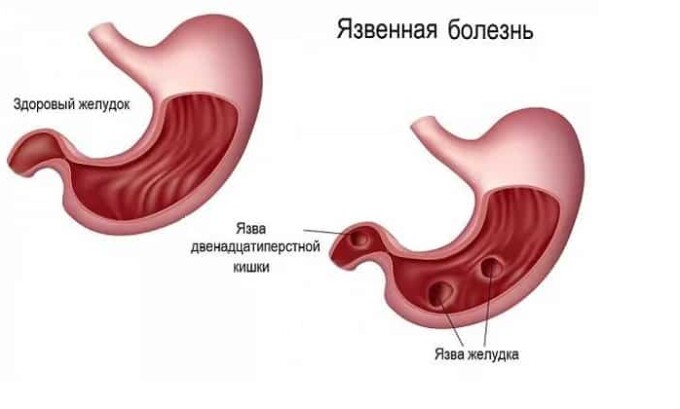 Наличие язвенной болезни может привести к возникновению панкреатита