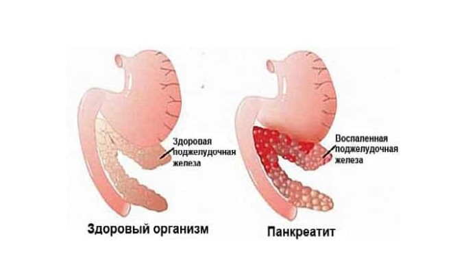 Панкреатит приводит к патологическим изменениям в железе