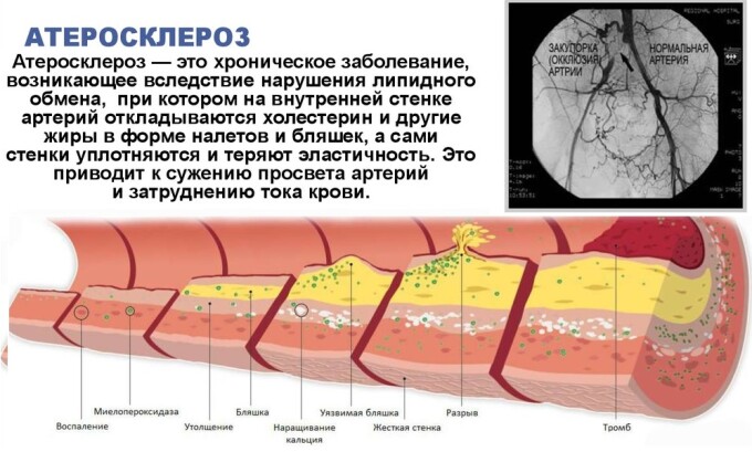 Запрещается носить компрессионное белье при атеросклерозе