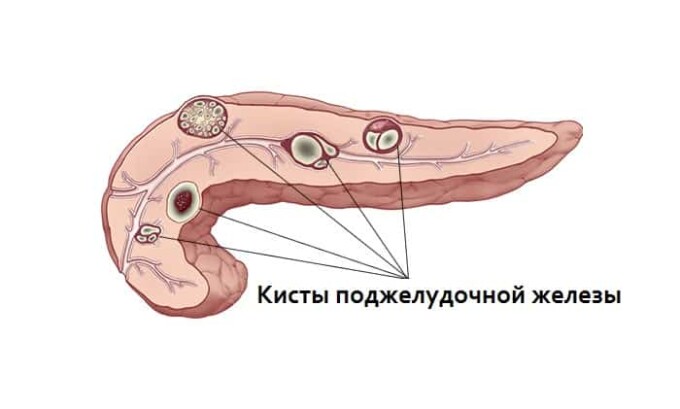 Если в поджелудочной железе обнаружены кисты, то необходима операци