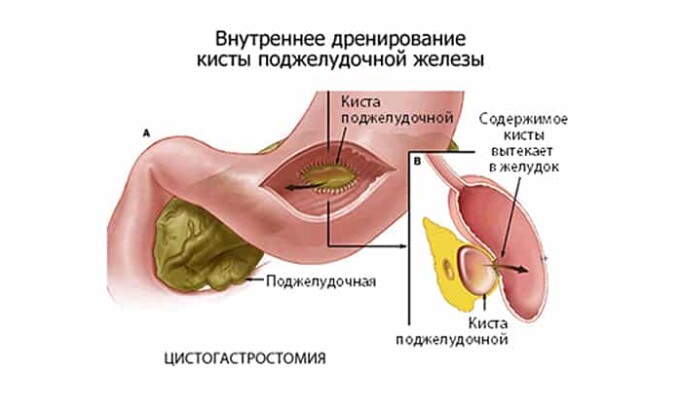 Процесс дренирования кисты поджелудочной железы, который назначается в этом случае, выполняется при помощи тонкой трубки, вводимой в полость