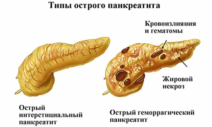 Дисфункция поджелудочной, при воспалении железы, превращается в панкреатит – не менее опасную болезнь, лечение которой базируется на медикаментозном, операционном и народном лечении