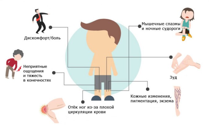 Основные симптомы варикоза