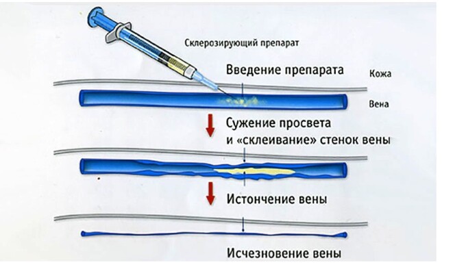 Склеротерапия - это методика, при которой в пораженные вены вводят специфический препарат, позволяющий регенерировать стенки сосудов