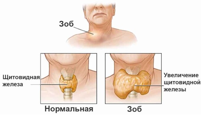 Наличие зоба щитовидной железы является основной причиной развития рака