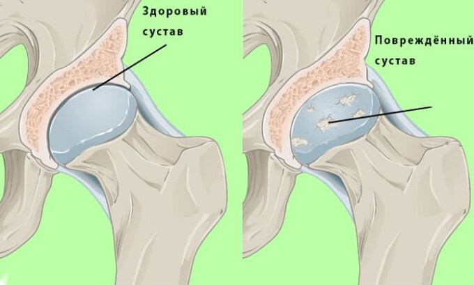 В результате ношения армейской обуви из достаточно грубых материалов, без каблука на подошве, по истечению некоторого времени, у военнослужащего солдата приводит к тому что у военнослужащего начинают страдать и портиться суставы