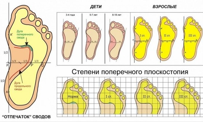 Проблема вросшего ногтя развивается из-за плоскостопия