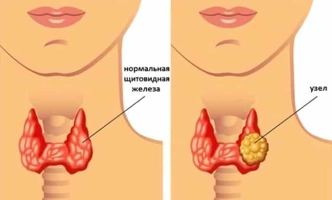 Узловой зоб чаще появляется у женщин, чем у мужчин