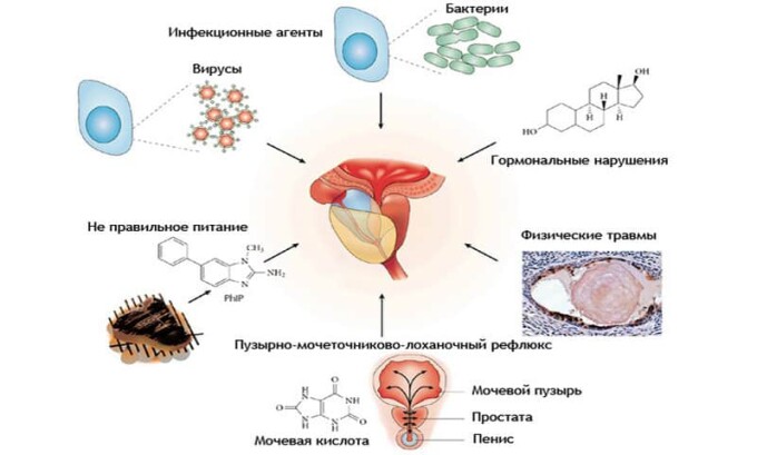 Основными причинами возникновения болезни являются переохлаждение организма, болезни, передающиеся половым путем, длительные воздержания или беспорядочная половая жизнь, травмы и снижение иммунной системы организма