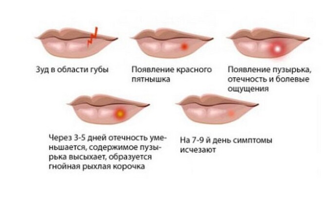 Высыпания на губах имеют несколько стадий развития