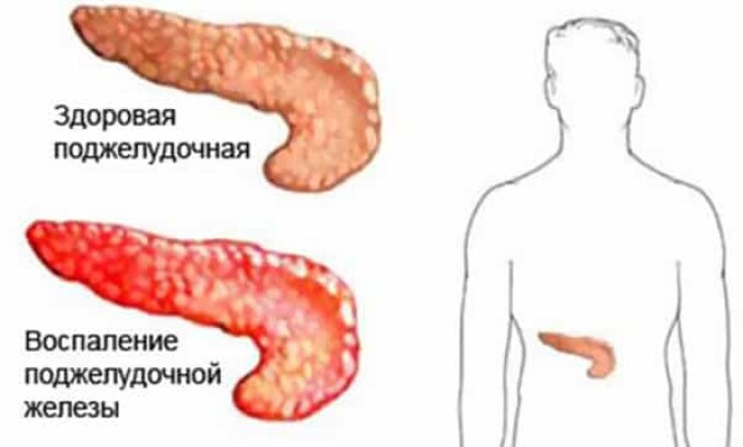 Панкреатит - воспаление поджелудочной железы