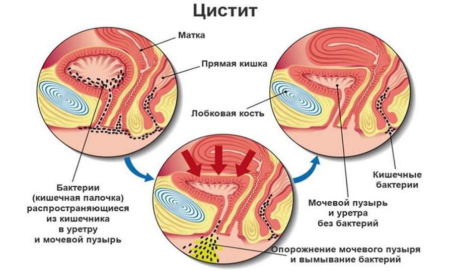 Можно ли при цистите принимать горячую ванну?
