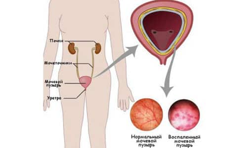 Цистит с кровью - это тяжелая форма заболевания мочевого пузыря, поэтому проявляться может с повышением температуры, появлением озноба и слабости во всем теле