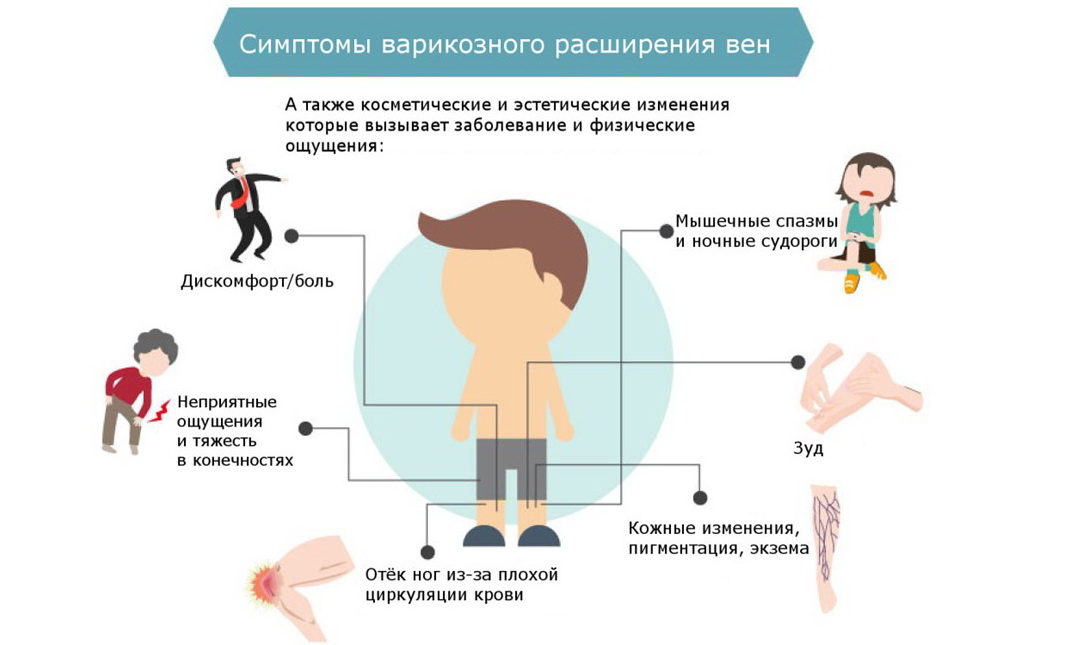 Лечебные и профилактические упражнения при варикозе