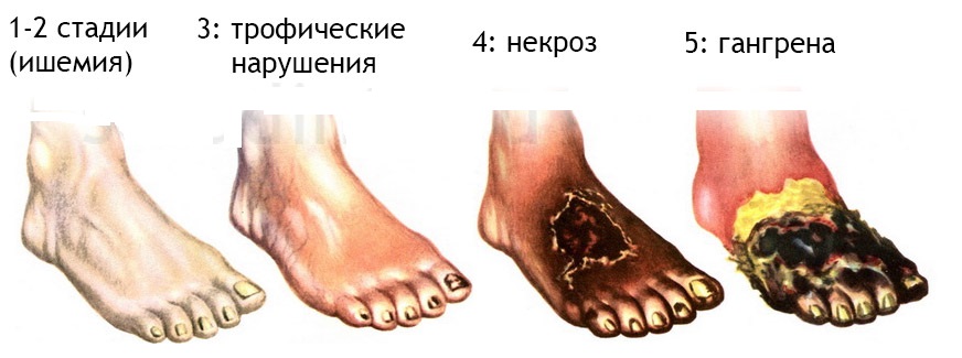 Если развилась при сахарном диабете гангрена