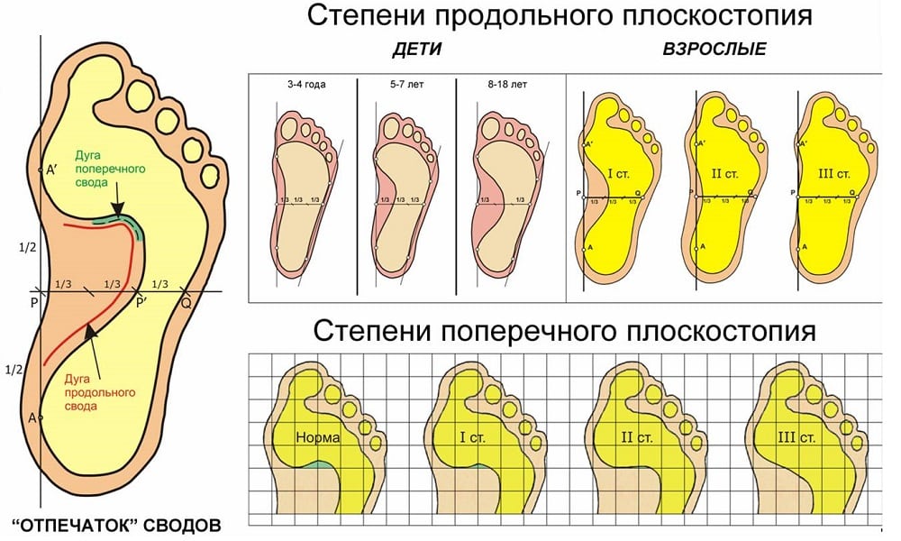 Как определить плоскостопие у ребёнка: симптоматика проявления, методы диагностики