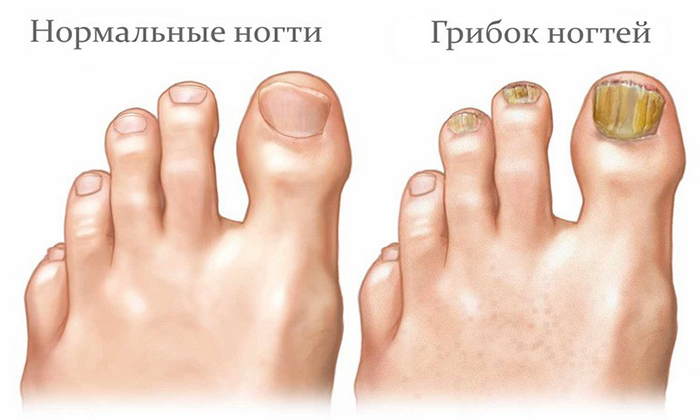 Разновидности средств удаления ногтя: причины, симптоматика, виды препаратов