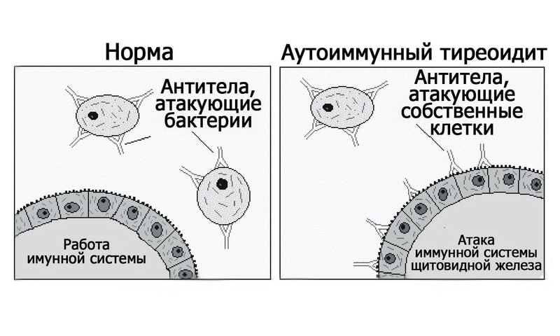 Внимание: хронический тиреоидит